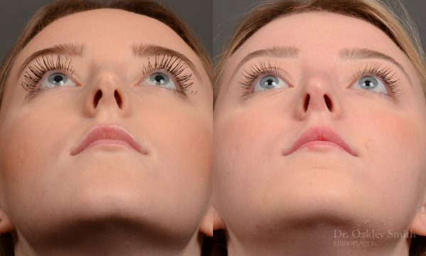 450 rhinoplasty, dr oakley smith, toronto, top surgeon, nose job