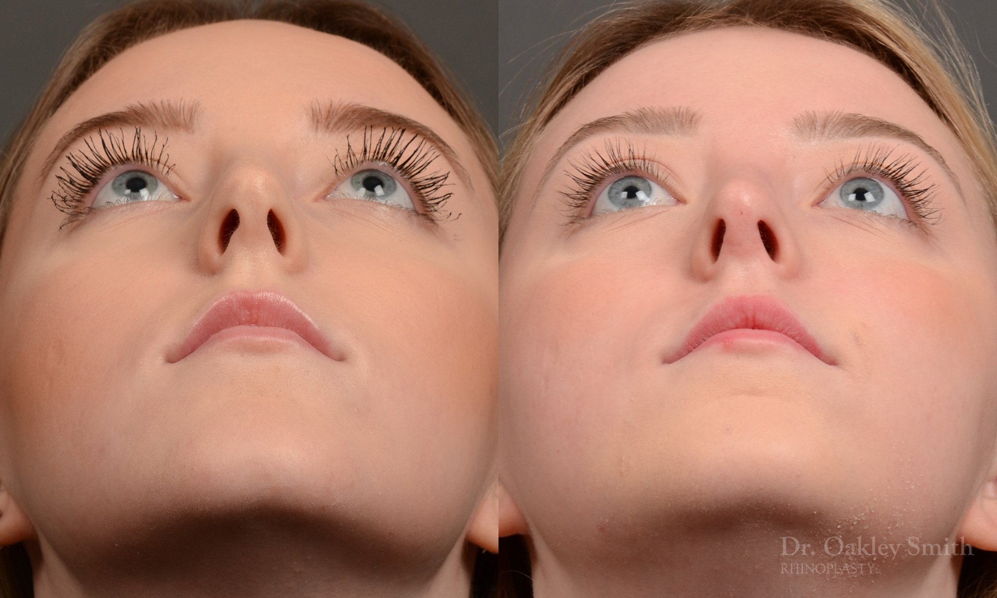 450 rhinoplasty, dr oakley smith, toronto, top surgeon, nose job