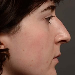 451 rhinoplasty, dr oakley smith, toronto, top surgeon, nose job