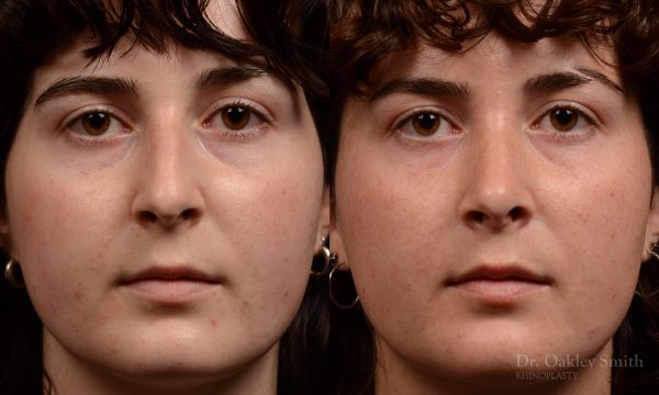 451 rhinoplasty, dr oakley smith, toronto, top surgeon, nose job