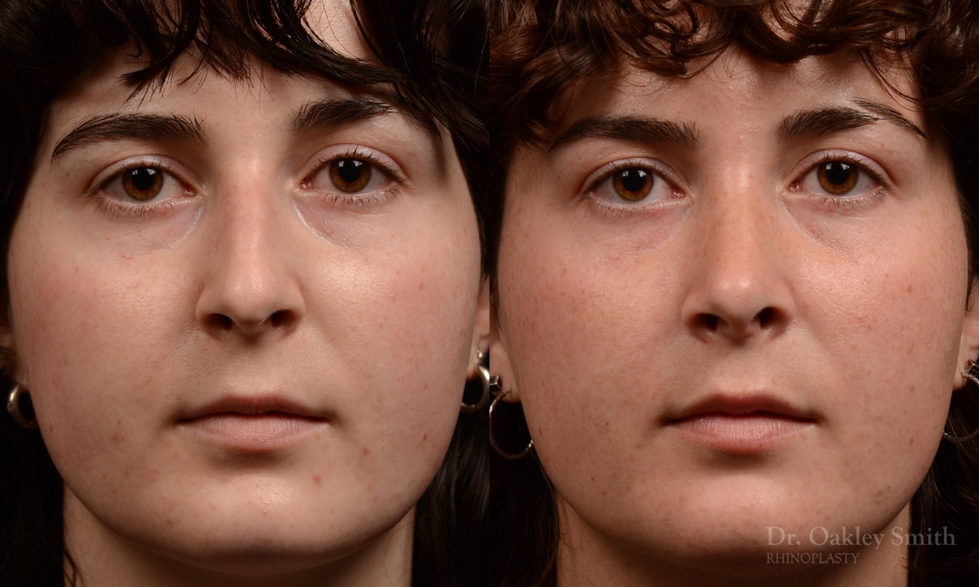 451 rhinoplasty, dr oakley smith, toronto, top surgeon, nose job