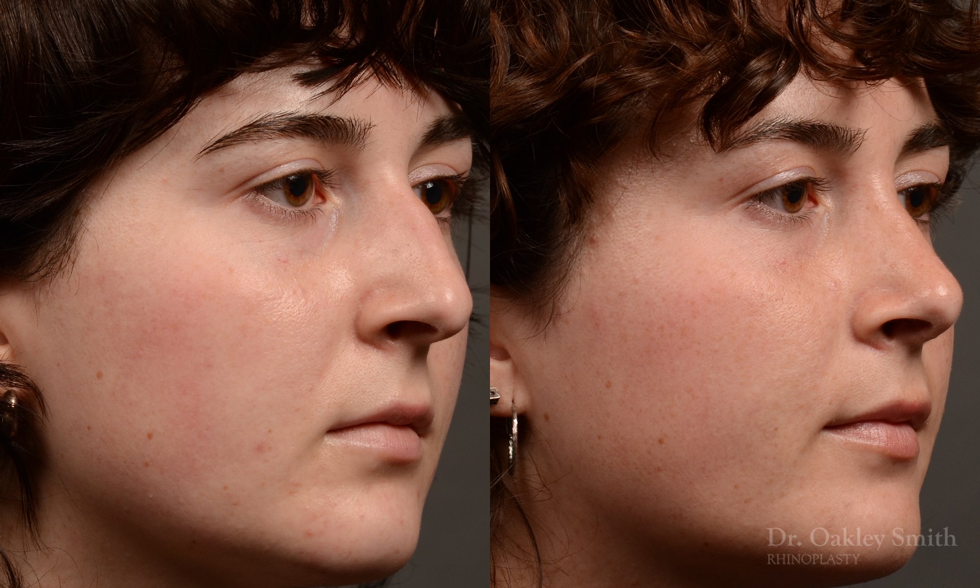451 rhinoplasty, dr oakley smith, toronto, top surgeon, nose job