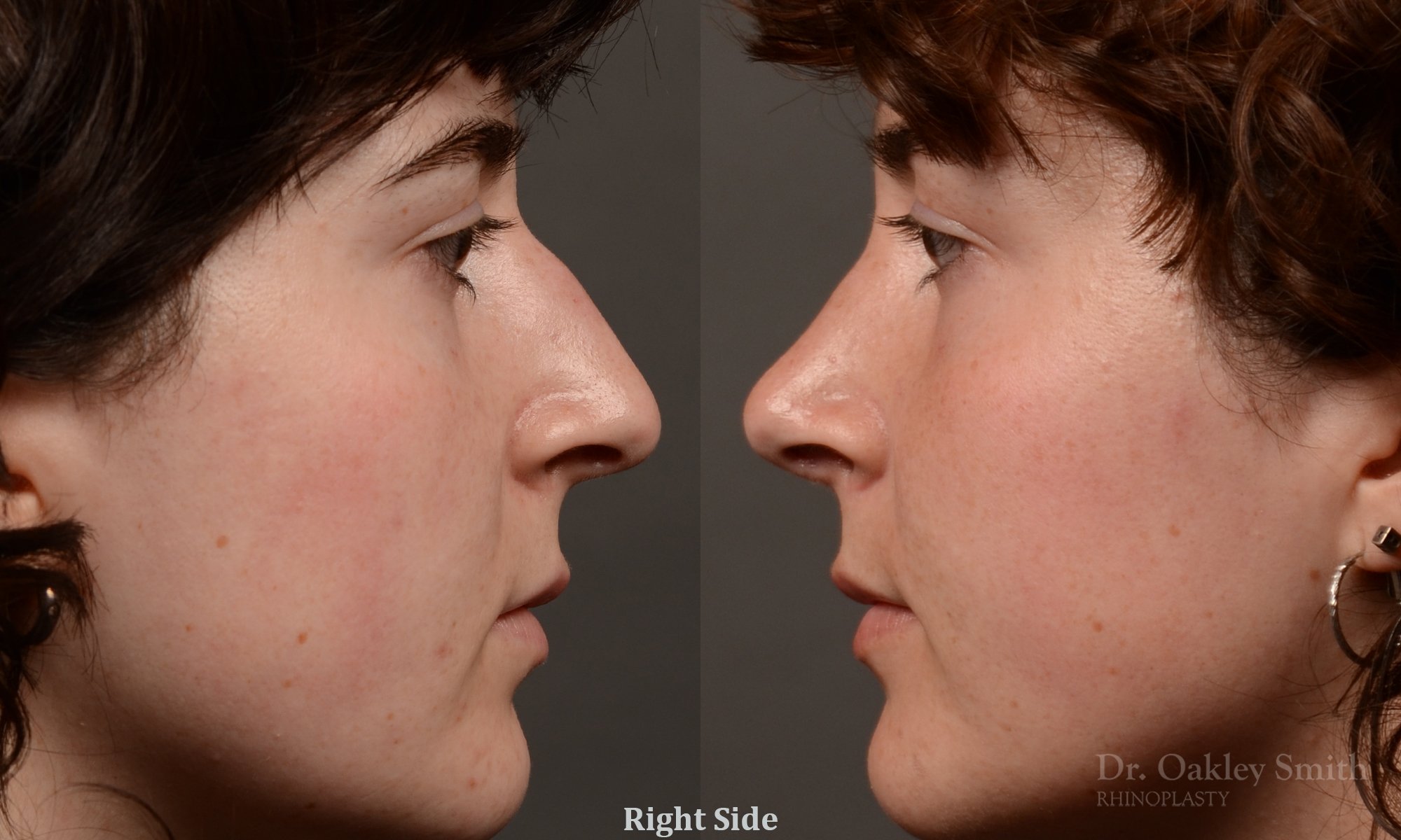 451 rhinoplasty, dr oakley smith, toronto, top surgeon, nose job