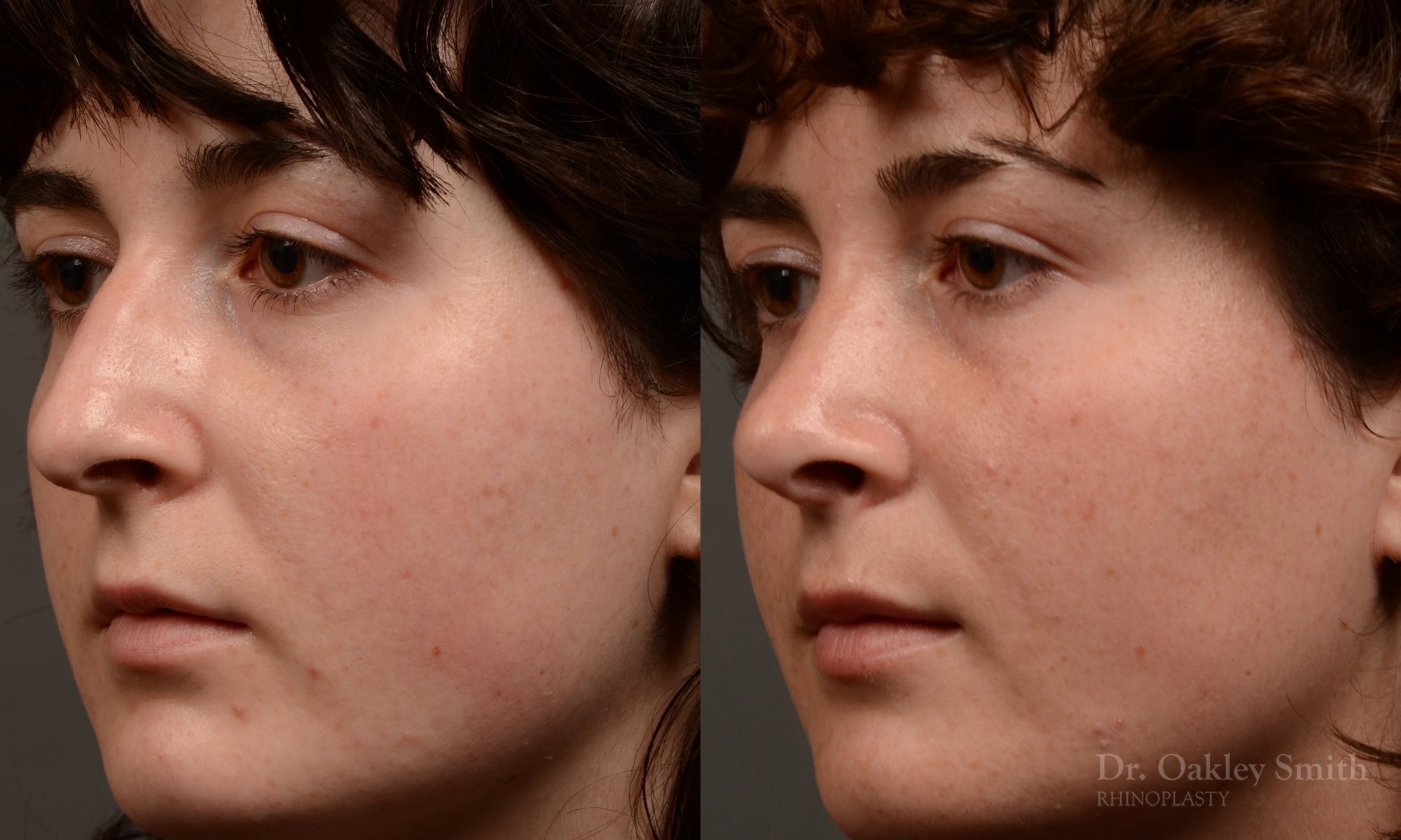 451 rhinoplasty, dr oakley smith, toronto, top surgeon, nose job