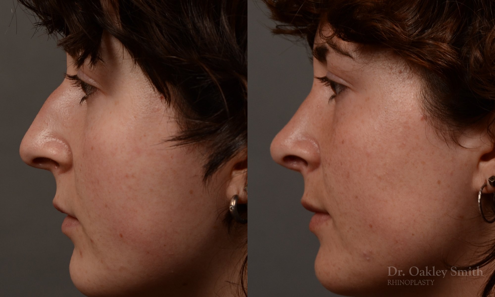 451 rhinoplasty, dr oakley smith, toronto, top surgeon, nose job