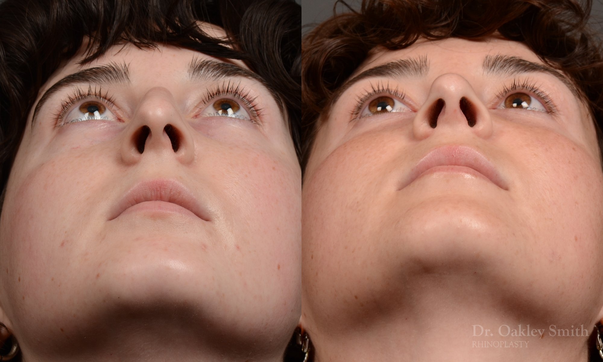 451 rhinoplasty, dr oakley smith, toronto, top surgeon, nose job
