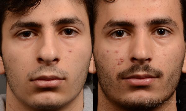 452 rhinoplasty, dr oakley smith, toronto, top surgeon, nose job