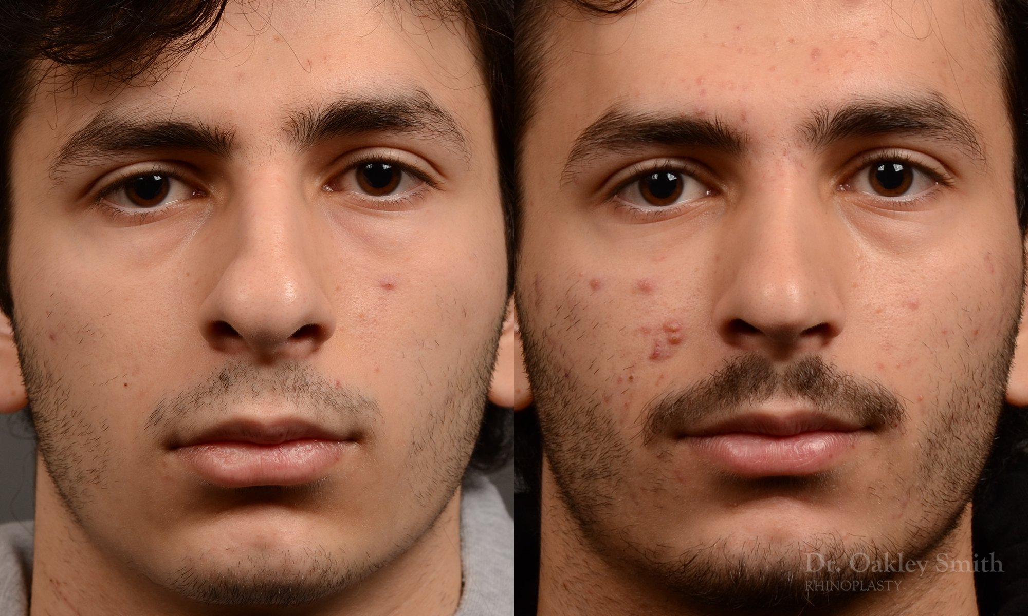 452 rhinoplasty, dr oakley smith, toronto, top surgeon, nose job