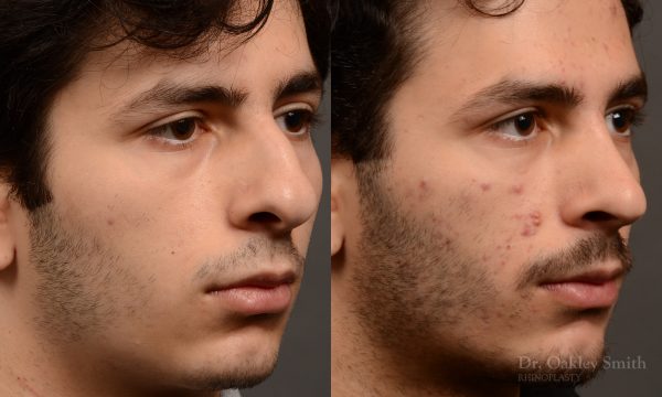 452 rhinoplasty, dr oakley smith, toronto, top surgeon, nose job