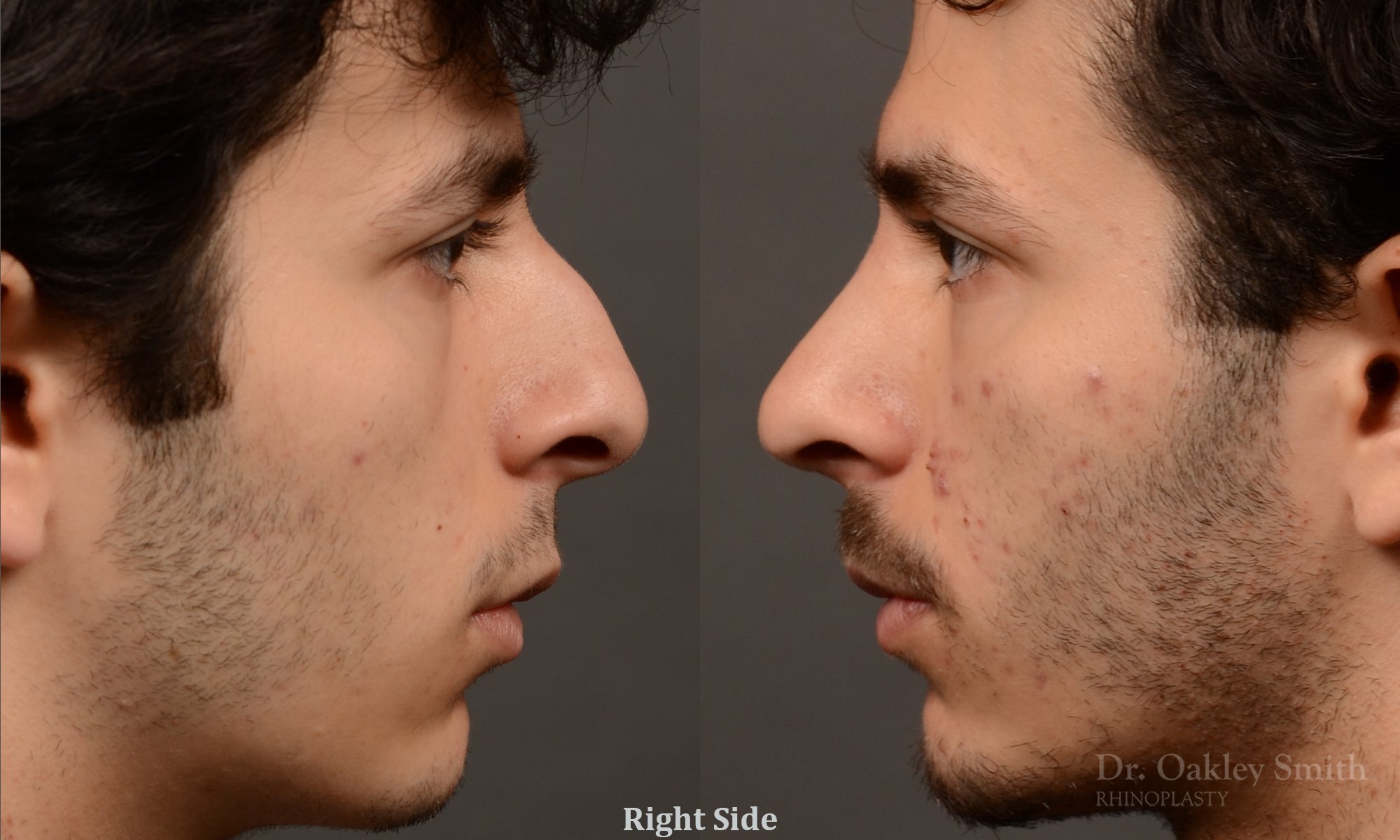 452 rhinoplasty, dr oakley smith, toronto, top surgeon, nose job