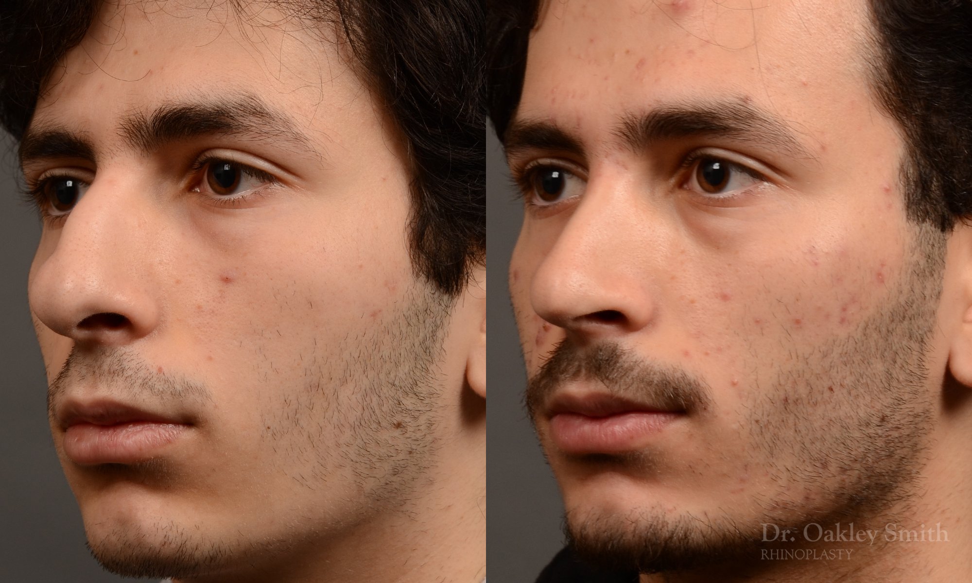 452 rhinoplasty, dr oakley smith, toronto, top surgeon, nose job