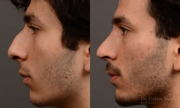 452 rhinoplasty, dr oakley smith, toronto, top surgeon, nose job