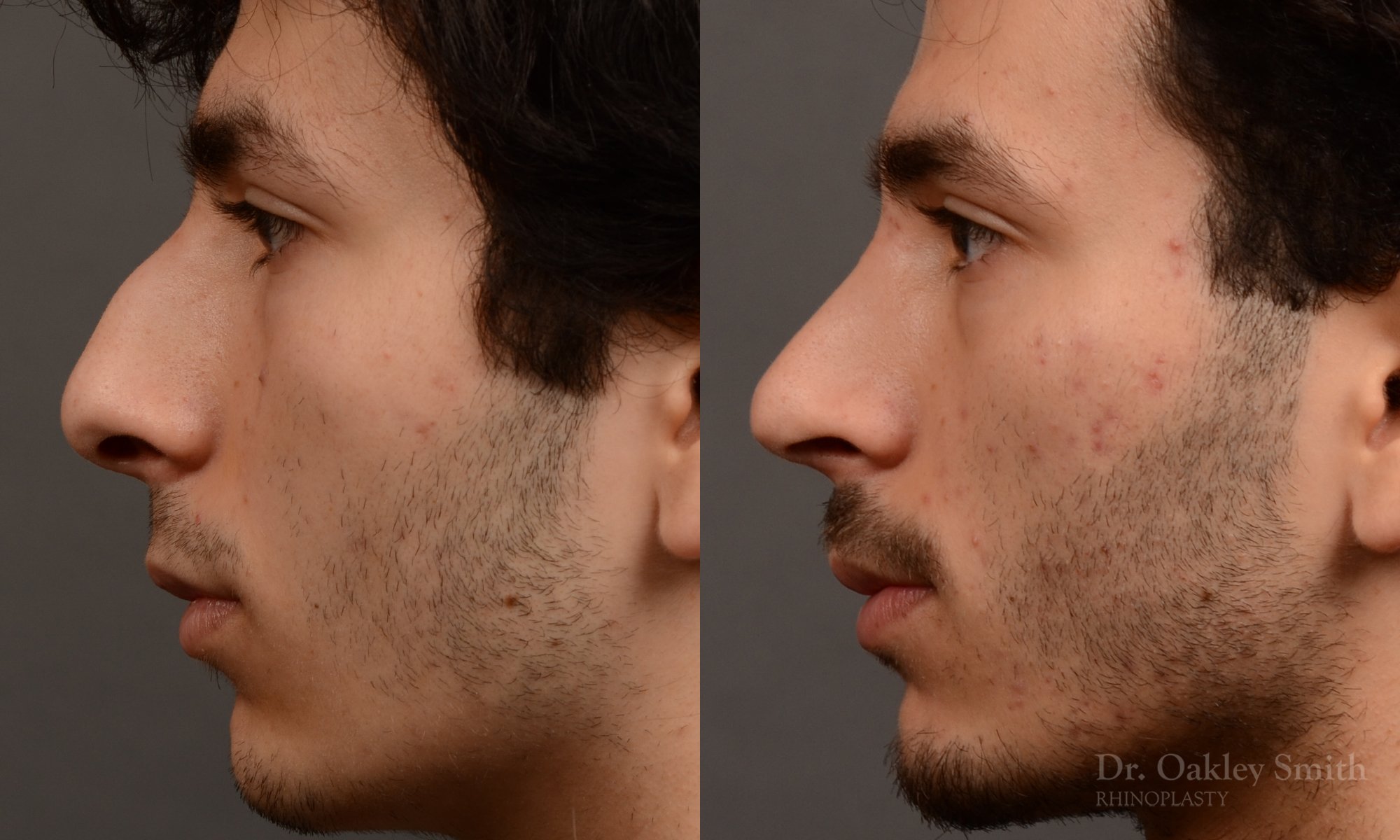 452 rhinoplasty, dr oakley smith, toronto, top surgeon, nose job