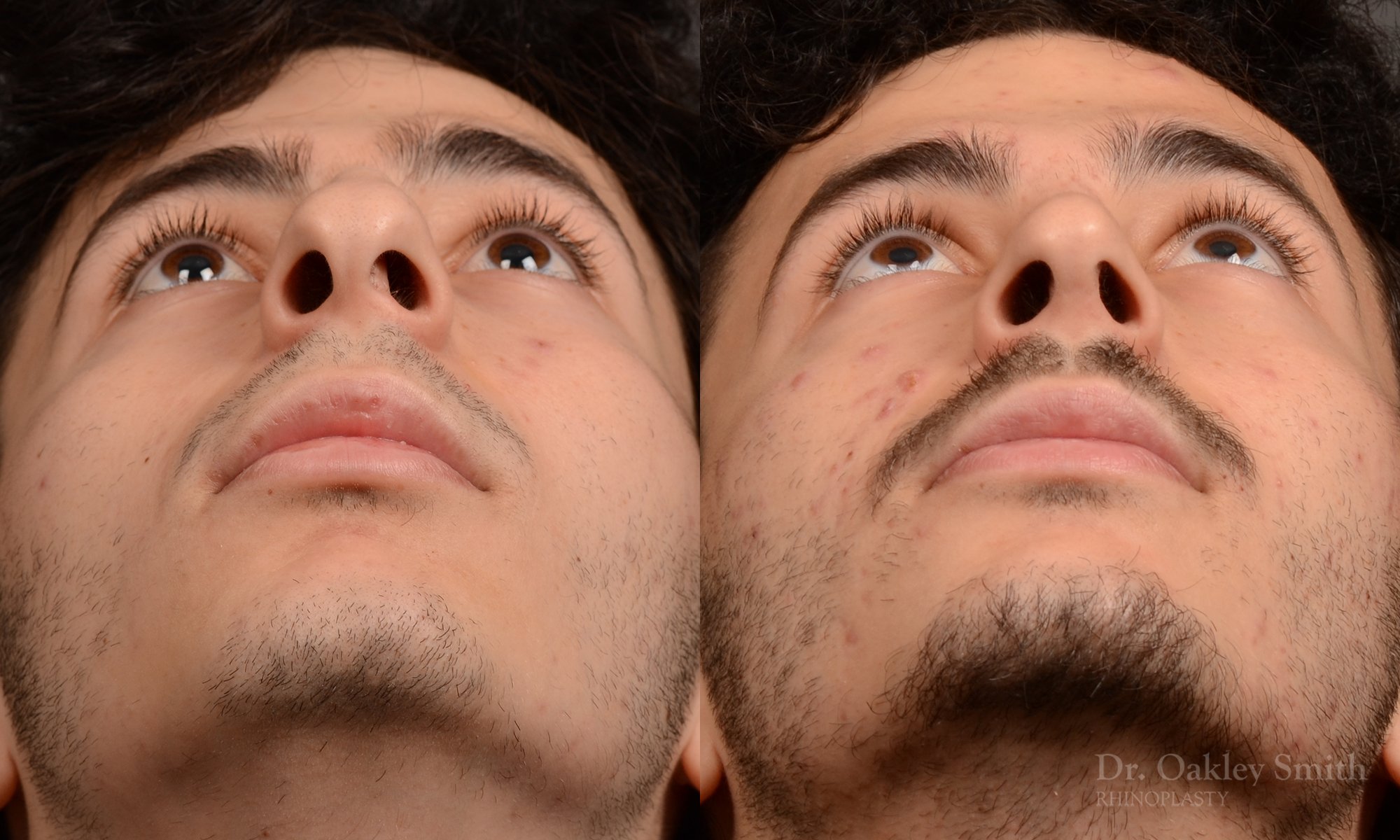 452 rhinoplasty, dr oakley smith, toronto, top surgeon, nose job