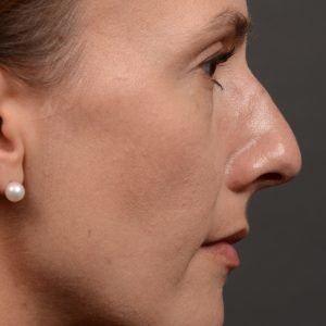 Rhinoplasty - Rhinoplasty Before and After Case 453