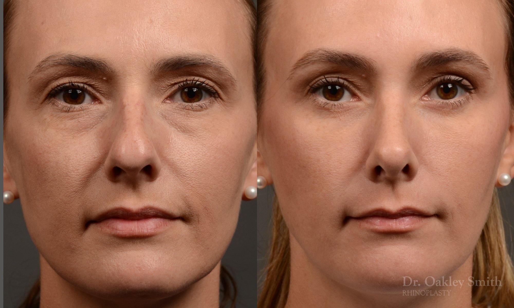 453 rhinoplasty, dr oakley smith, toronto, top surgeon, nose job