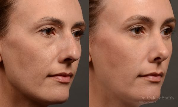 453 rhinoplasty, dr oakley smith, toronto, top surgeon, nose job