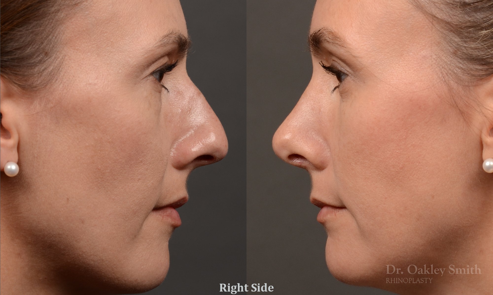 453 rhinoplasty, dr oakley smith, toronto, top surgeon, nose job