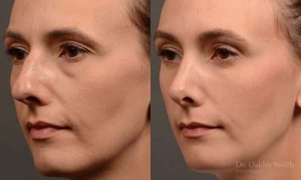 453 rhinoplasty, dr oakley smith, toronto, top surgeon, nose job