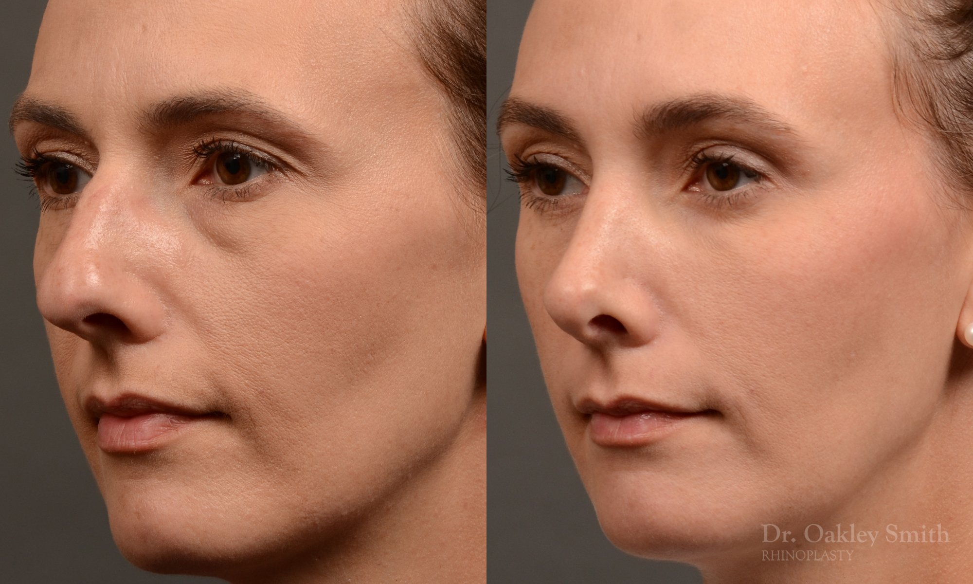 453 rhinoplasty, dr oakley smith, toronto, top surgeon, nose job