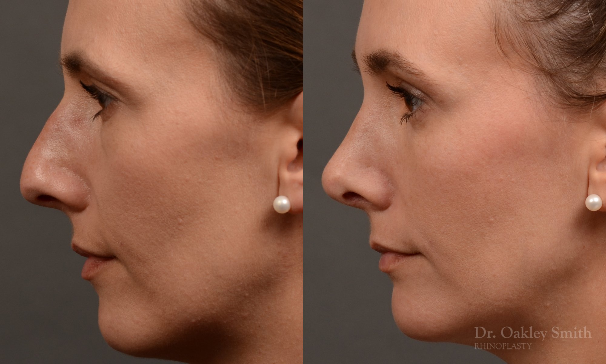 453 rhinoplasty, dr oakley smith, toronto, top surgeon, nose job