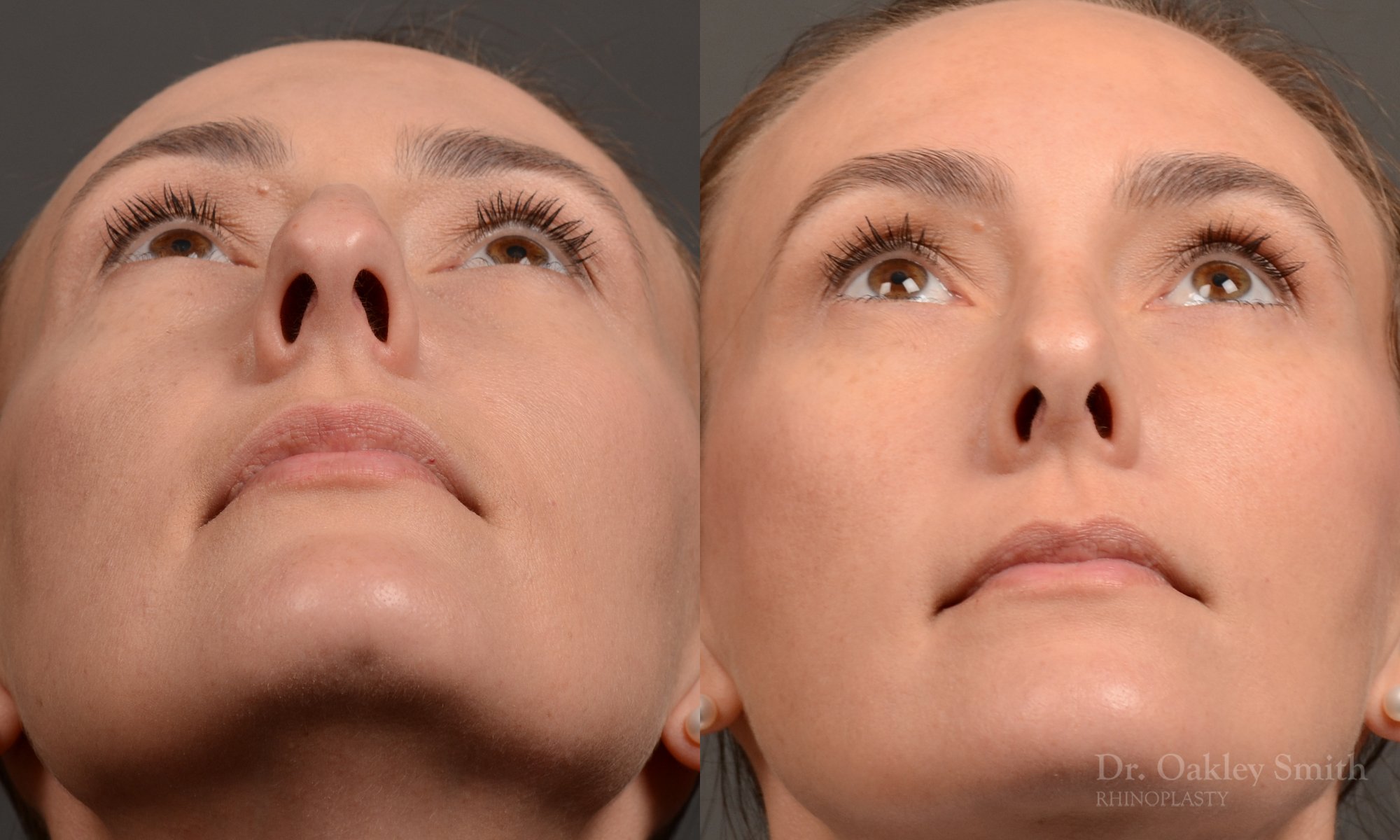 453 rhinoplasty, dr oakley smith, toronto, top surgeon, nose job