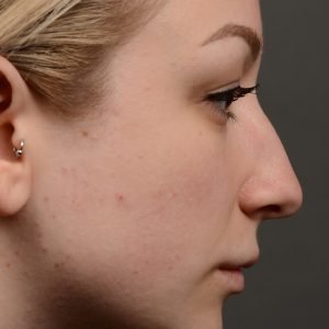Rhinoplasty - Rhinoplasty Before After Case 454