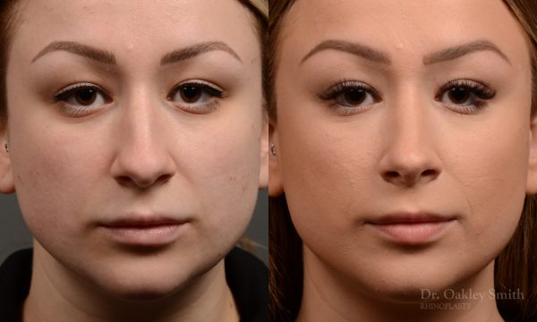 454 rhinoplasty, dr oakley smith, toronto, top surgeon, nose job