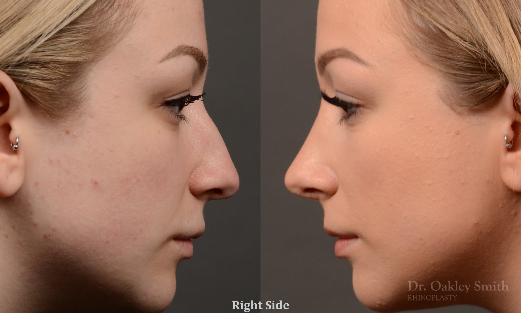 454 rhinoplasty, dr oakley smith, toronto, top surgeon, nose job