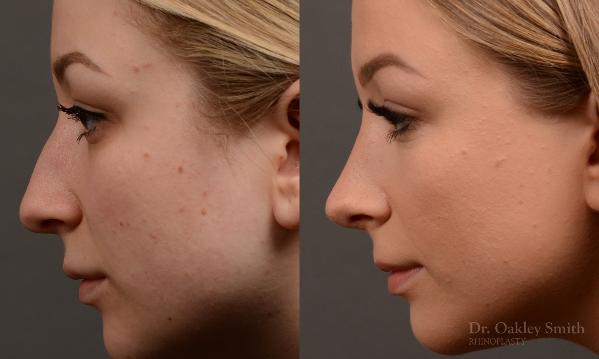 454 rhinoplasty, dr oakley smith, toronto, top surgeon, nose job