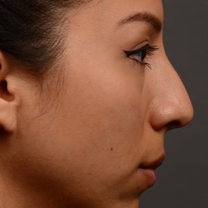 Rhinoplasty - Rhinoplasty Before and After – Case 460