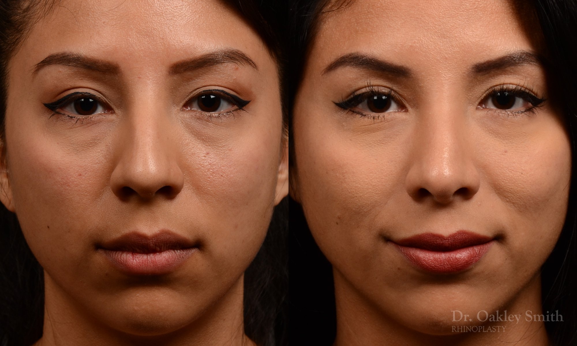 Rhinoplasty - Rhinoplasty Before and After – Case 460