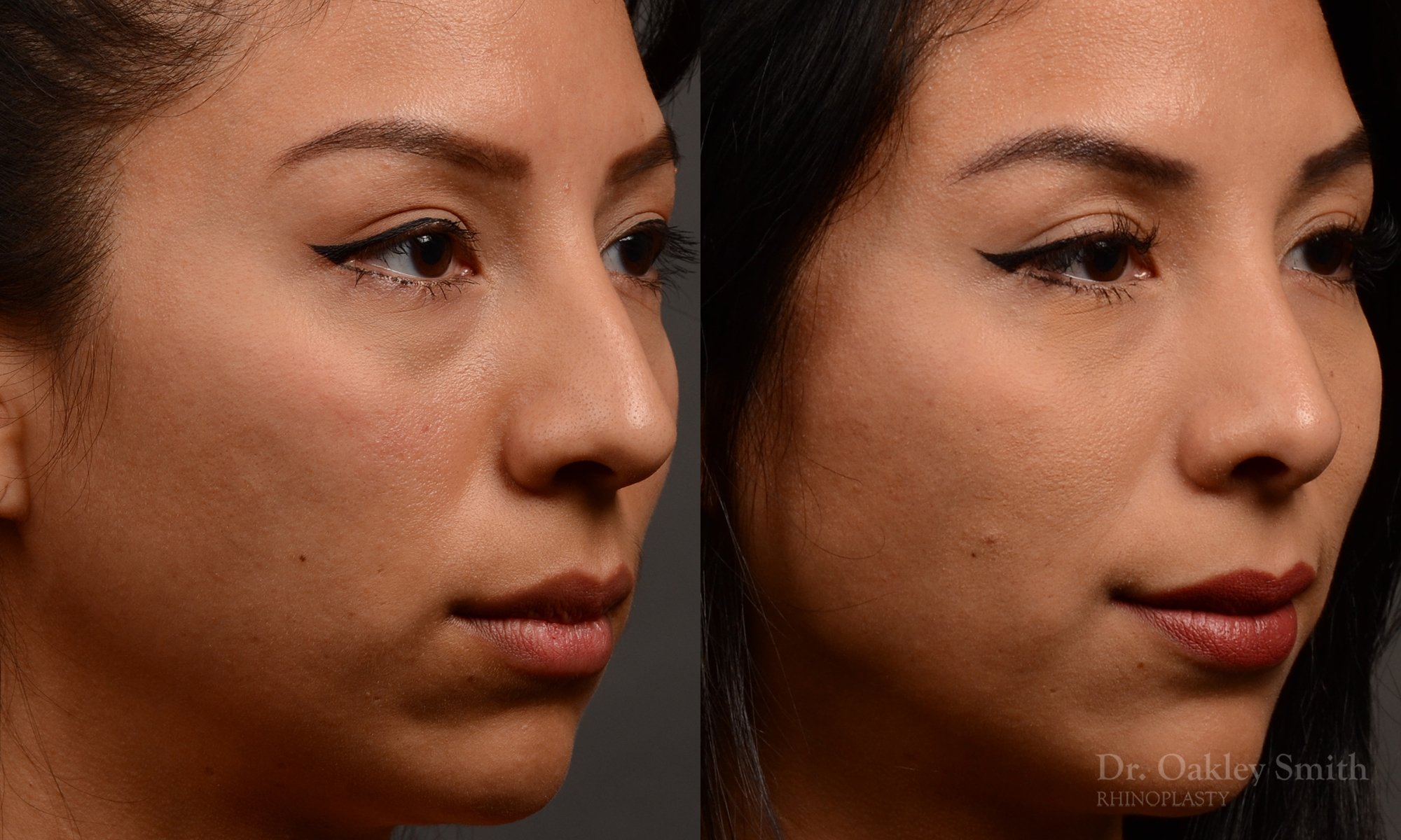 Rhinoplasty - Rhinoplasty Before and After – Case 460