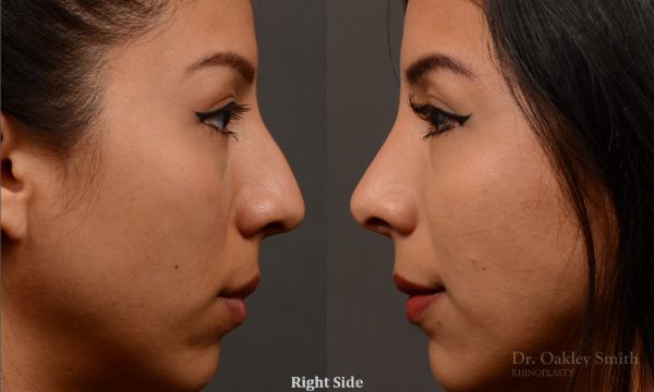 Rhinoplasty - Rhinoplasty Before and After – Case 460