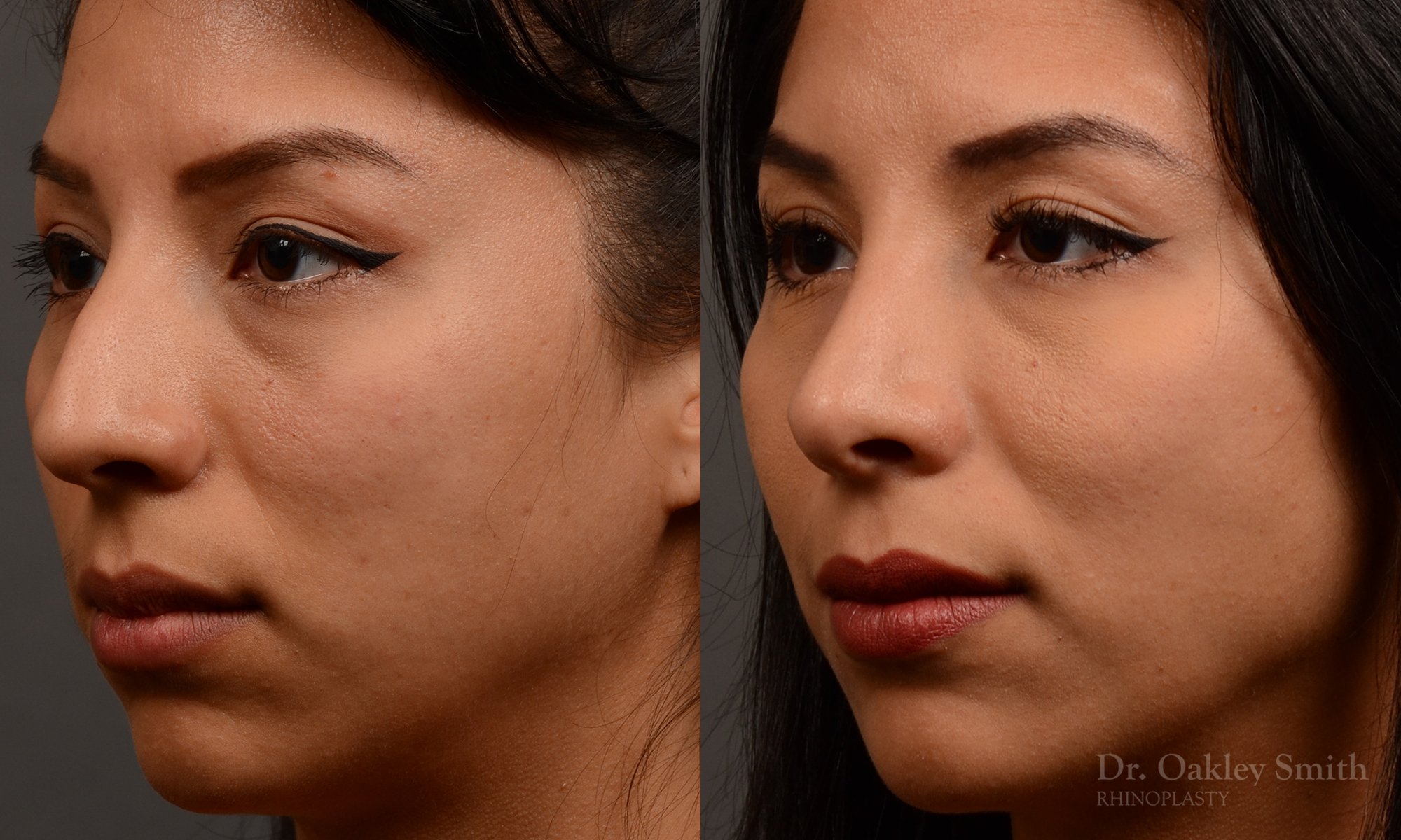 Rhinoplasty - Rhinoplasty Before and After – Case 460