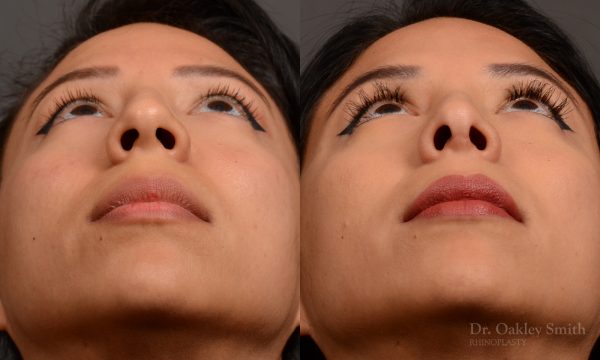 Rhinoplasty - Rhinoplasty Before and After – Case 460