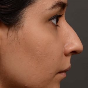 456 rhinoplasty, dr oakley smith, toronto, top surgeon, nose job
