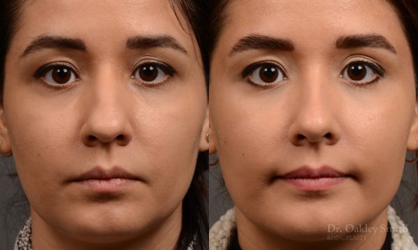 456 rhinoplasty, dr oakley smith, toronto, top surgeon, nose job