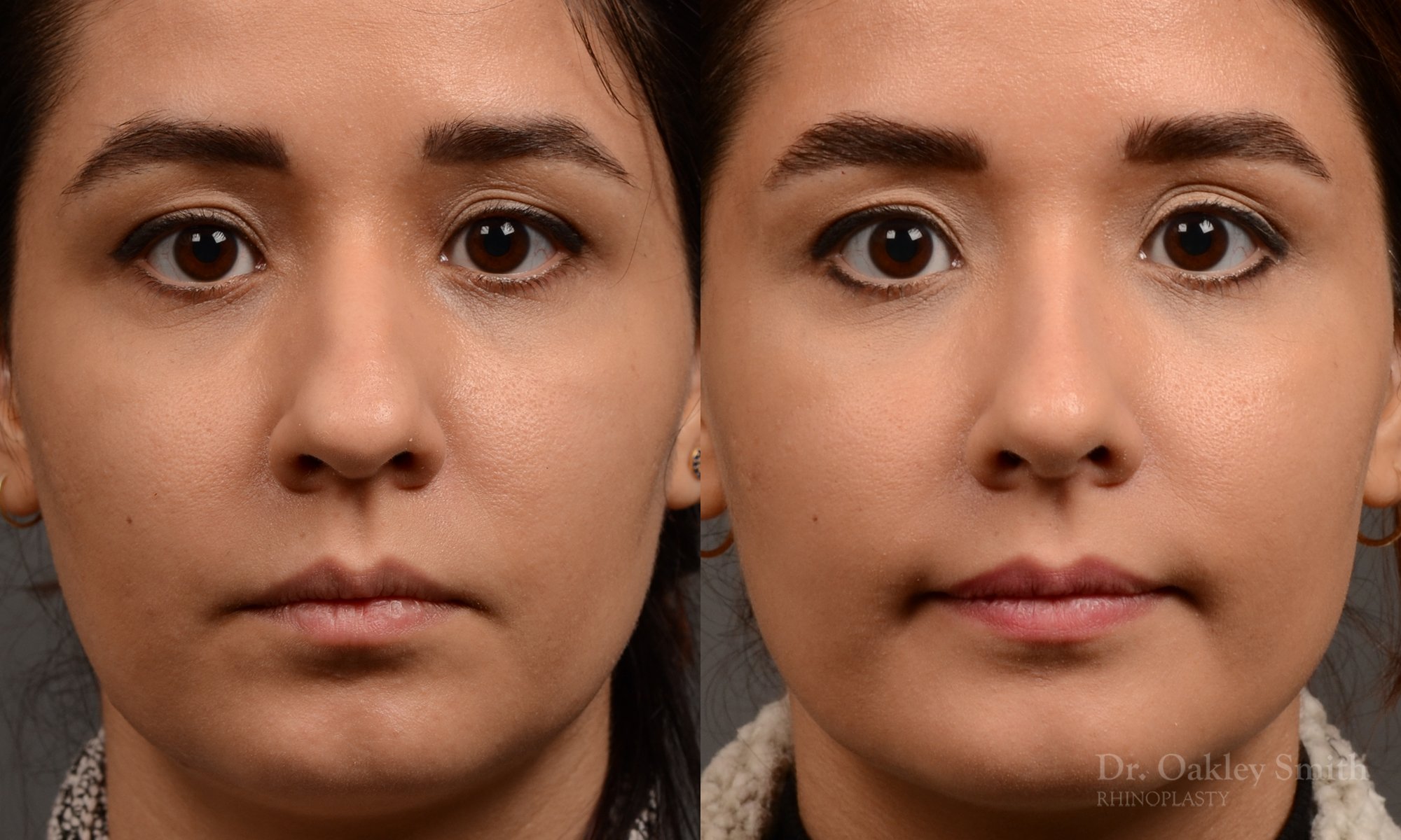 456 rhinoplasty, dr oakley smith, toronto, top surgeon, nose job