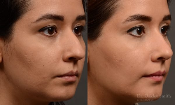 456 rhinoplasty, dr oakley smith, toronto, top surgeon, nose job