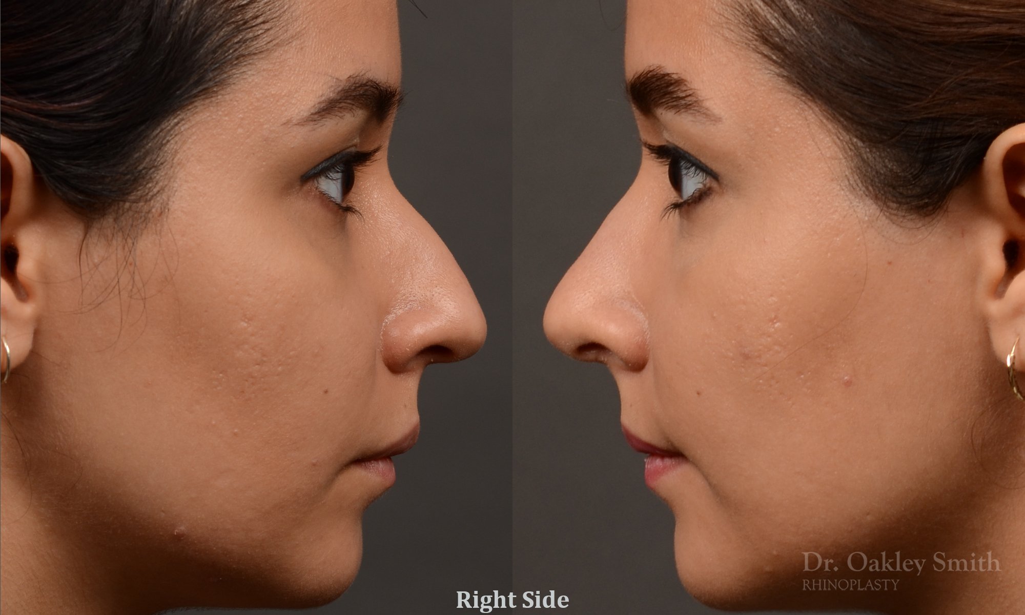 456 rhinoplasty, dr oakley smith, toronto, top surgeon, nose job