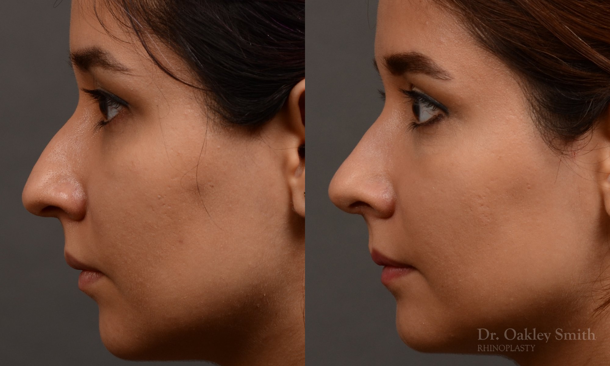 456 rhinoplasty, dr oakley smith, toronto, top surgeon, nose job
