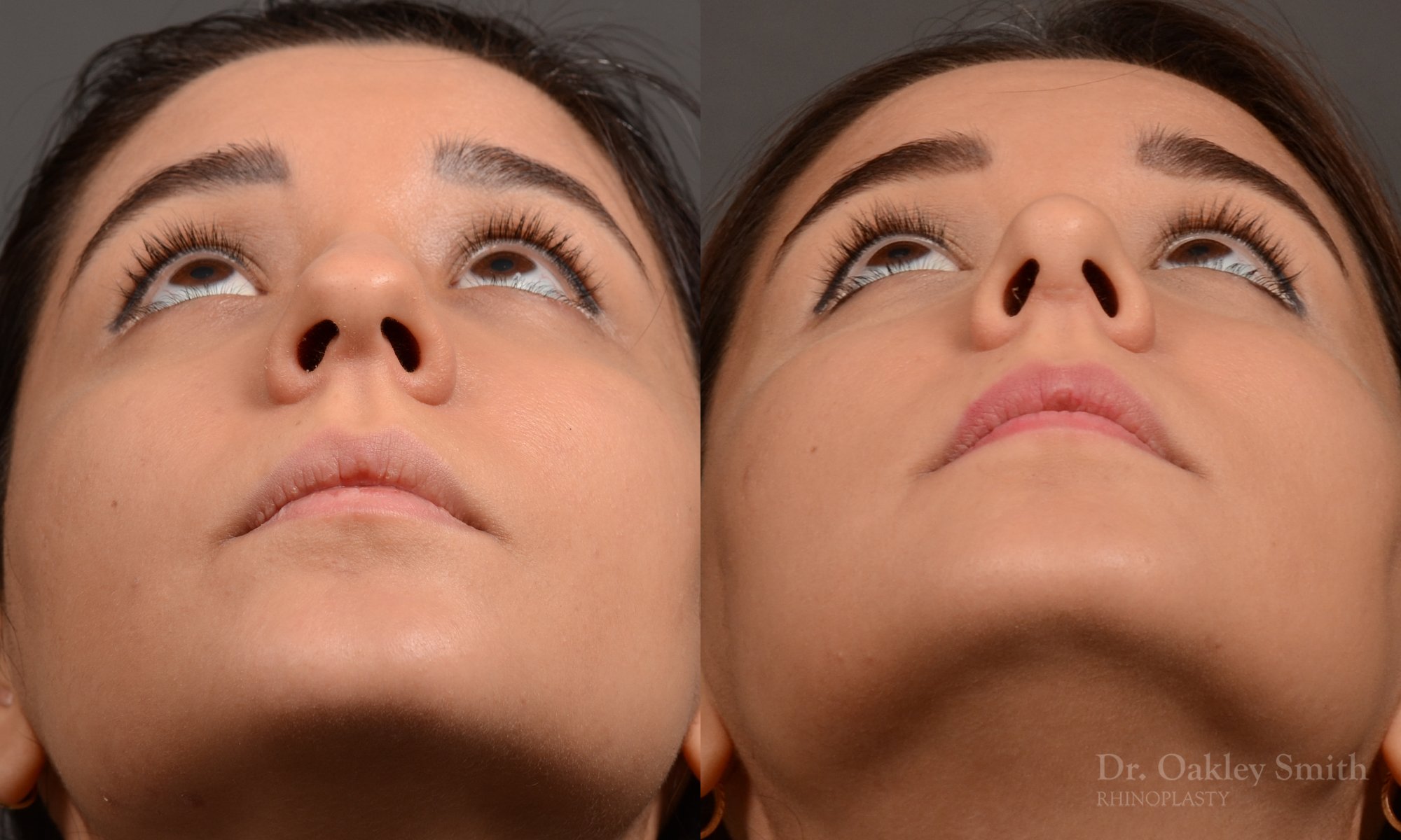 Rhinoplasty - Rhinoplasty Before and After Case 456