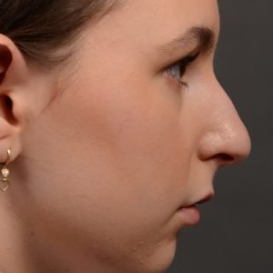 457 rhinoplasty, dr oakley smith, toronto, top surgeon, nose job