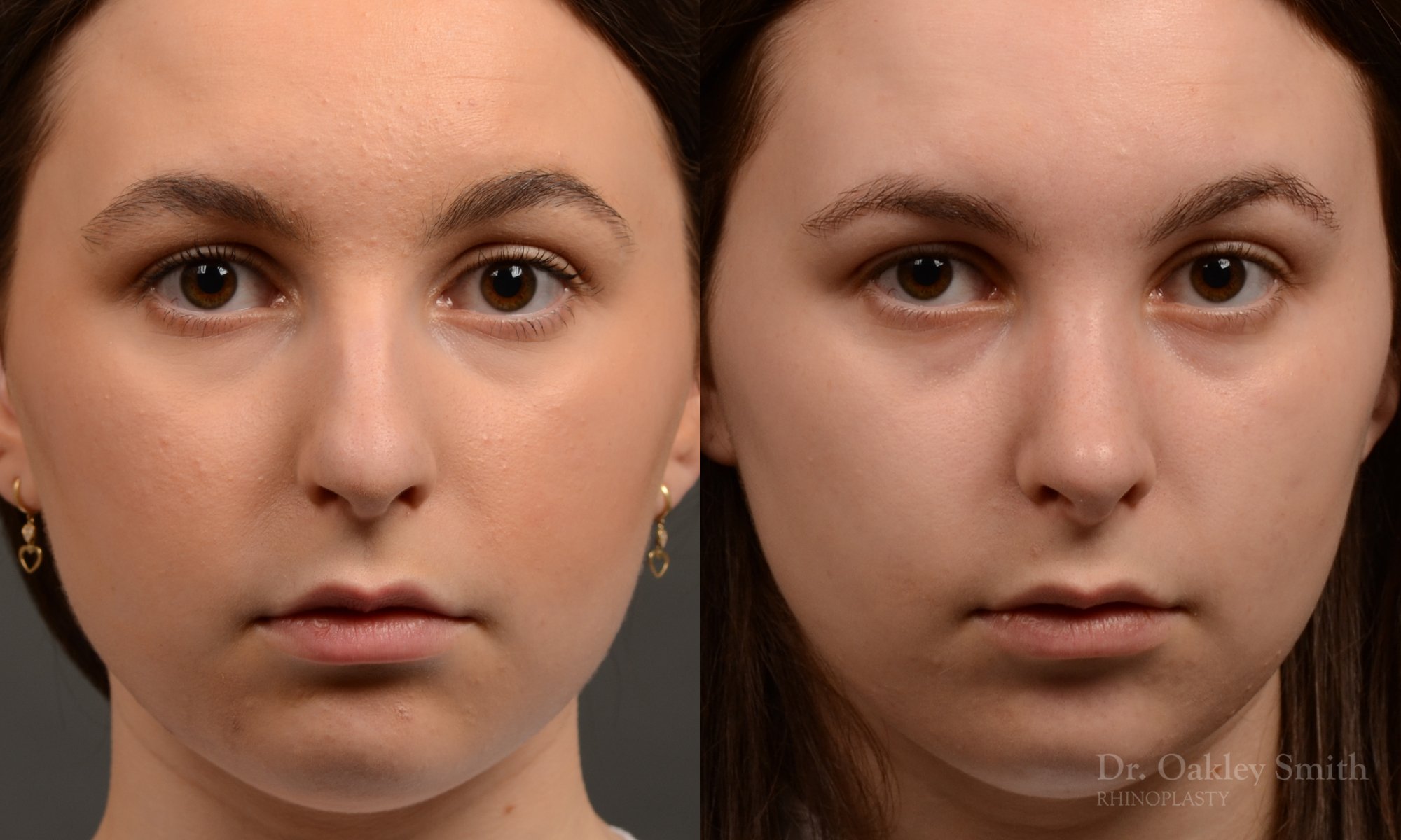 457 rhinoplasty, dr oakley smith, toronto, top surgeon, nose job