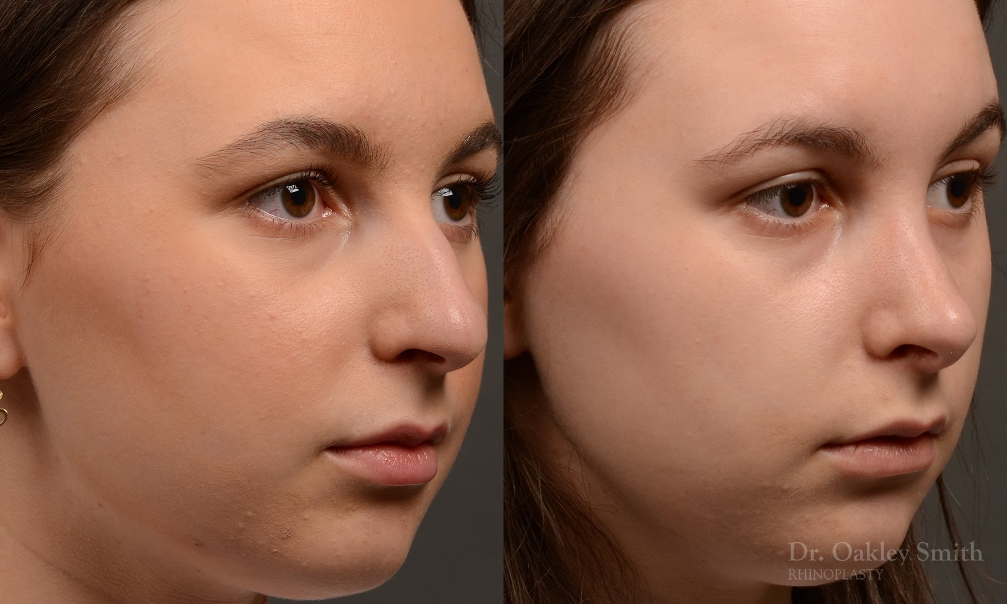 457 rhinoplasty, dr oakley smith, toronto, top surgeon, nose job
