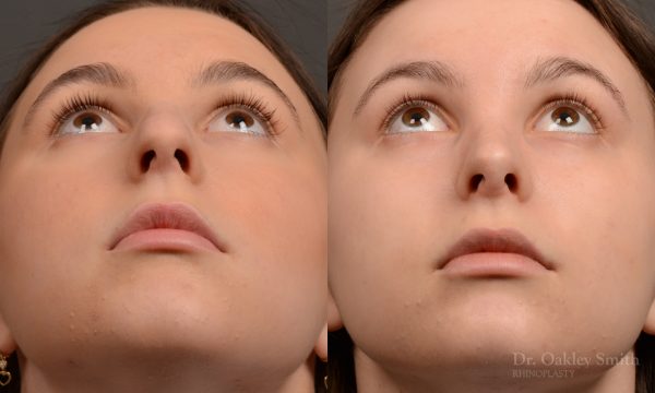 457 rhinoplasty, dr oakley smith, toronto, top surgeon, nose job