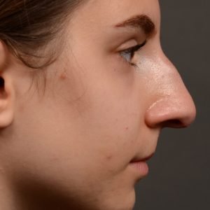 458 rhinoplasty, dr oakley smith, toronto, top surgeon, nose job