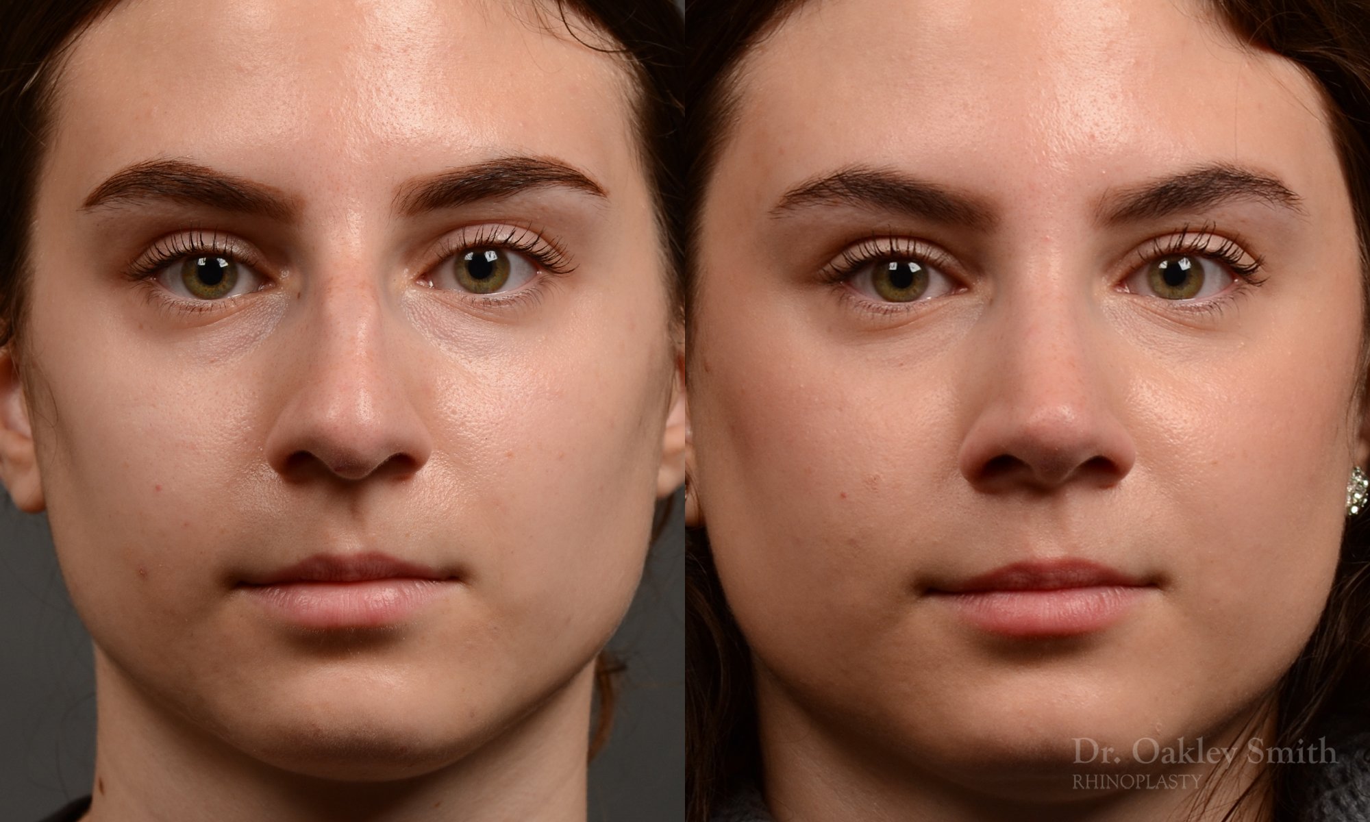 458 rhinoplasty, dr oakley smith, toronto, top surgeon, nose job