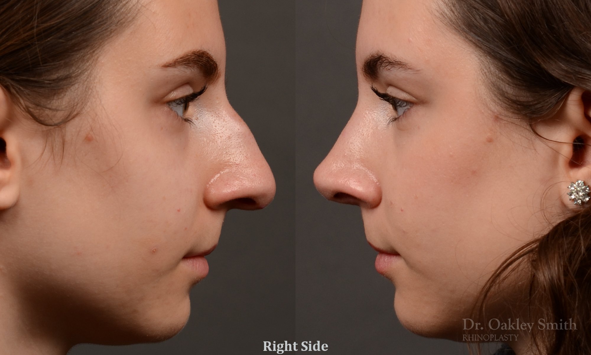 458 rhinoplasty, dr oakley smith, toronto, top surgeon, nose job